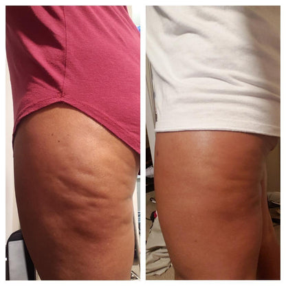 Massageöl gegen Cellulite